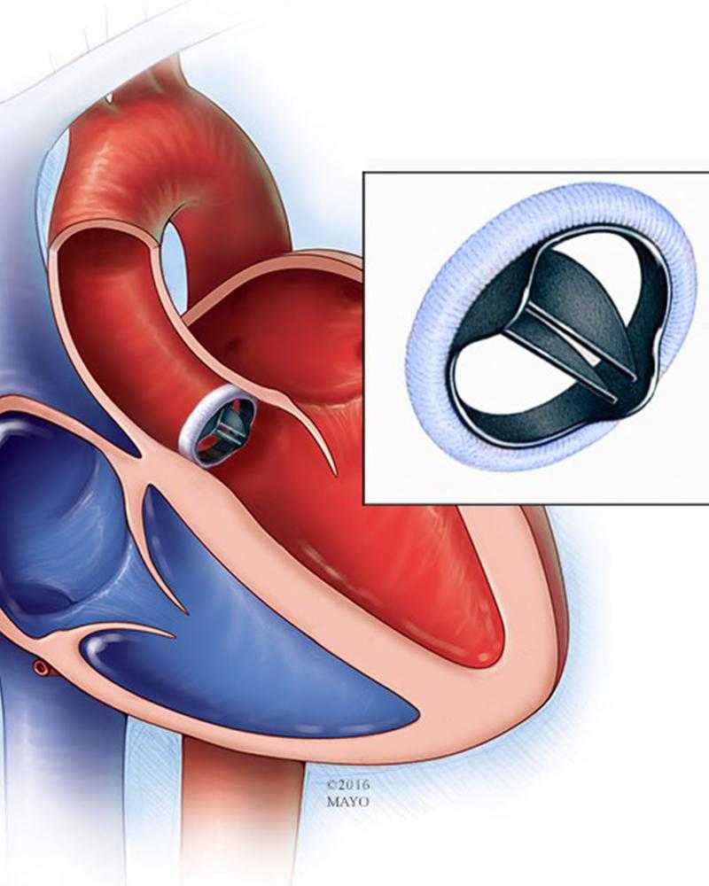 Как клапан делает операция. Искусственный аортальный клапан сердца. Искусственный митральный клапан сердца. Аортального митрального клапана механический. Митральный и аортальный клапан.