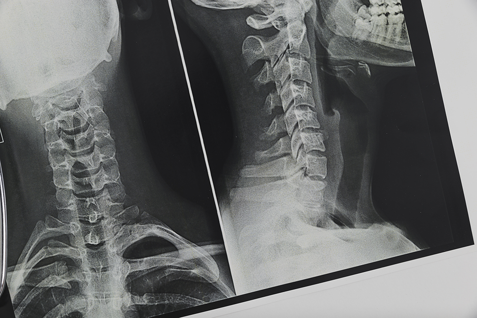 Рентген позвоночника. зачем нужен и как делается рентген позвоночника?