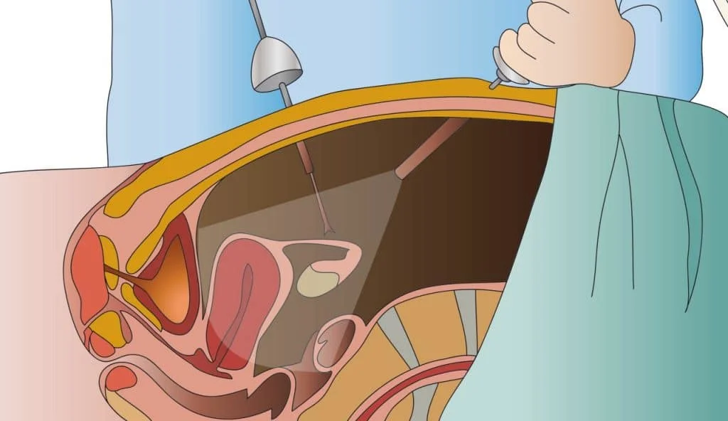 Пролапс органов таза у женщин: рекомендации по хирургическому лечению | университетская клиника