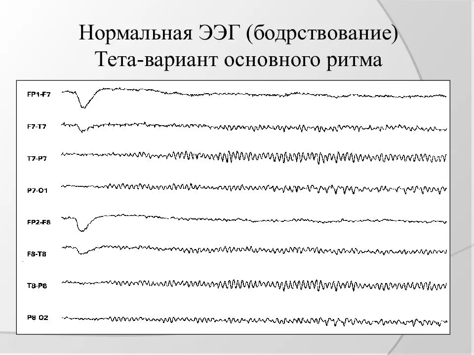 Показатели ээг. Ритмы ЭЭГ график. Эпилептиформные феномены на ЭЭГ что это. Нормальная ЭЭГ. ЭЭГ отклонения.