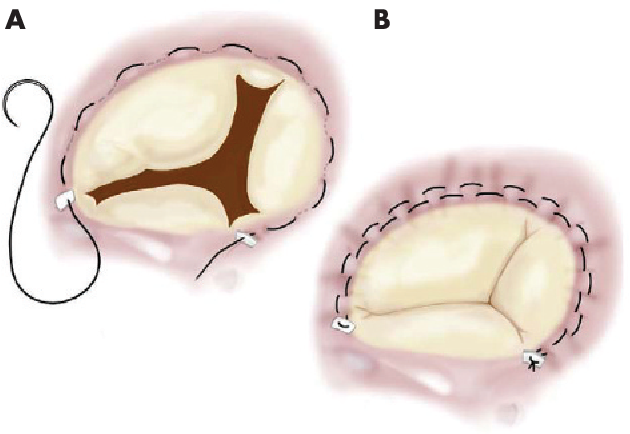 Операция по замене (протезированию) клапана сердца - кому показана, как проводится, реабилитация