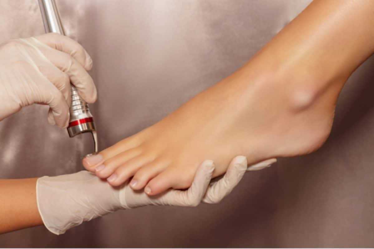 Лечение грибка врач. Лазерная терапия ногтевого грибка. Зачистка ногтя на ногах лазером.
