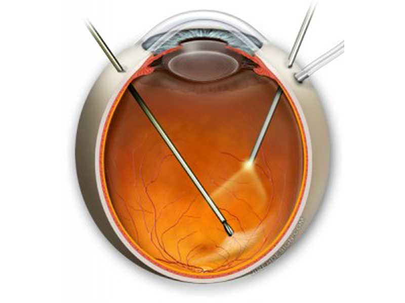 Отслоение сетчатки глаза - лечение, операция, симптомы и причины. витректомия 25g