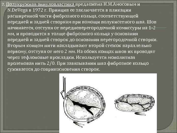 Транскатетерное протезирование аортального клапана (tavi) • русский доктор