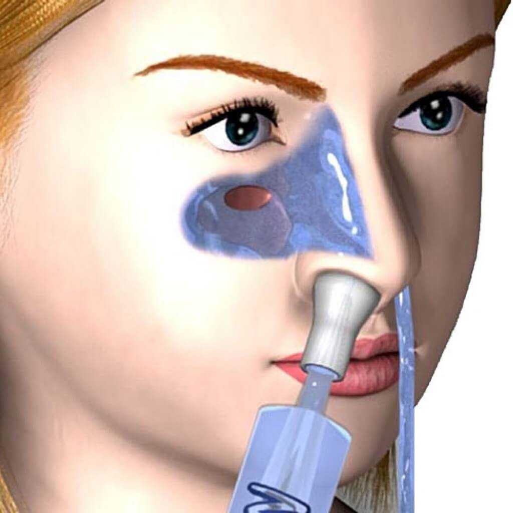 Промывание носа по методу кукушки: особенности проведения процедуры