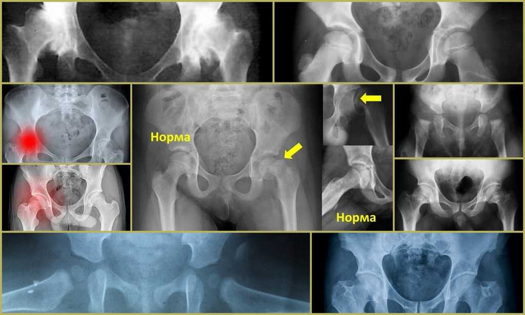 Рентгенография тбс: особенности проведения, диагностические возможности и расшифровка