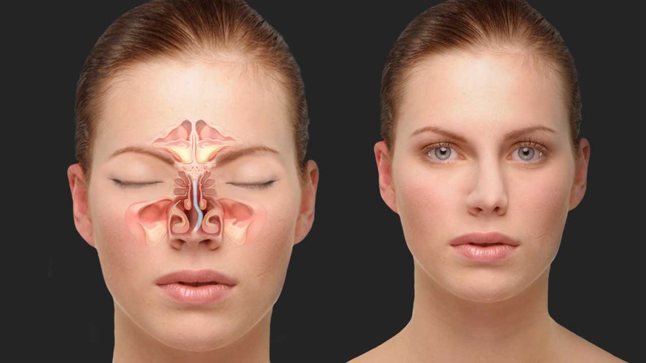 Эндоскопия носа - что показывает эндоскопия полости носа и пазух, больно ли, как делается