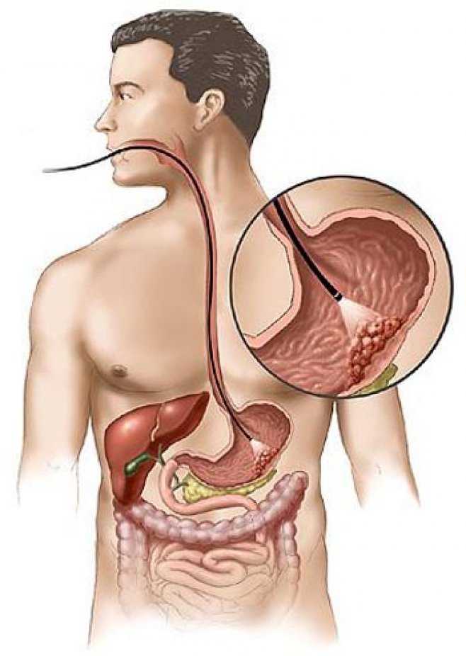 Гастроскопия желудка: как подготовится к фгдс, диета перед исследованием