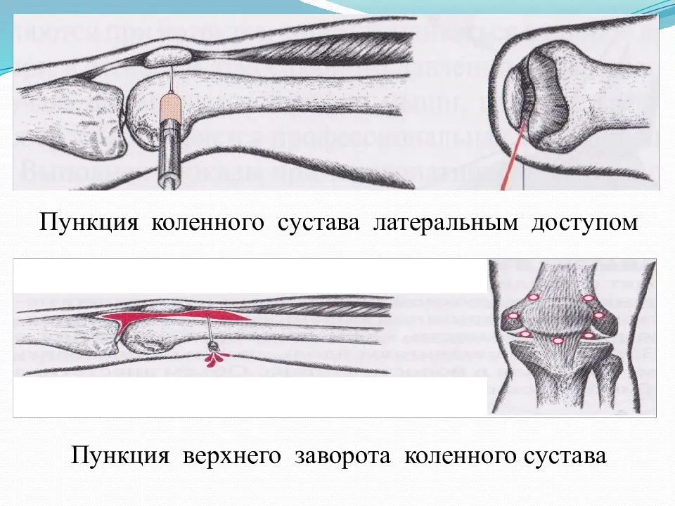 Киста бейкера коленного сустава, причины и лечение, размеры для операции