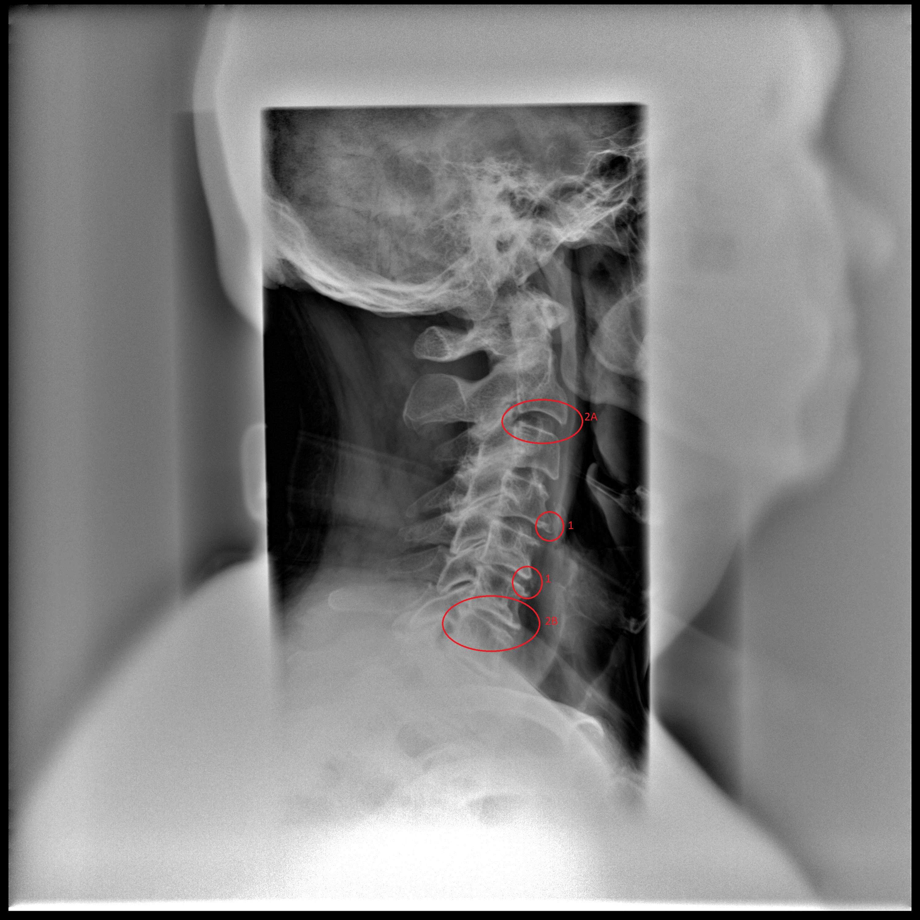 Рентген пояснично-крестцового отдела позвоночника: что показывает