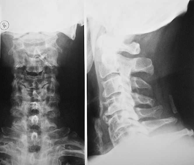 Что такое рентгенография позвоночника и как её делают?