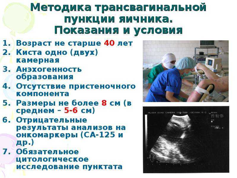Сперматоцеле