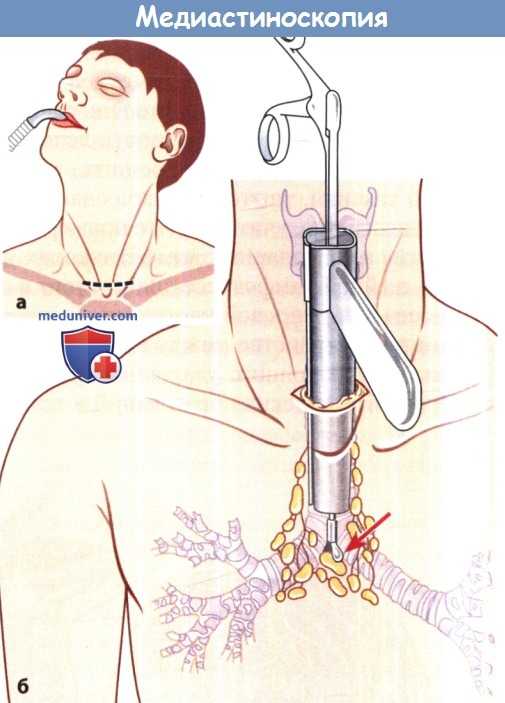 Влок крови: показания и противопоказания. процедура внутривенного лазерного облучения крови