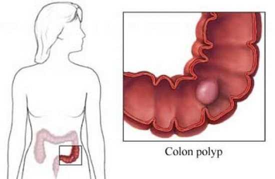 Все про полипы в организме человека: полипы в желудке и желчном пузыре. часть 2 * клиника диана в санкт-петербурге