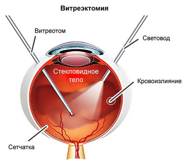 При каких заболеваниях показана витрэктомия Восстанавливается ли зрение после операции и как избежать рецидива Разновидности: микроинвазивная, передняя, задняя
