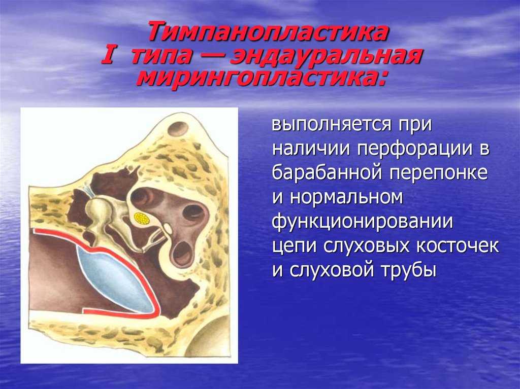 Где можно сделать мирингопластику Диагностика разрыва и показания к проведению операции Послеоперационный период и возможные осложнения после хирургического вмешательства
