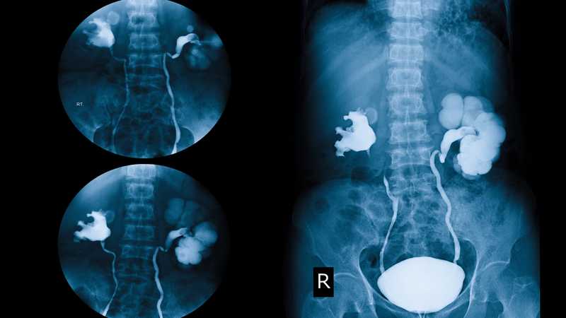 Как делают рентген мочевого пузыря Особенности проведения цистографии Показания и противопоказания для прохождения исследования Альтернативные методы и расшифровка снимков