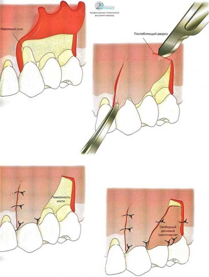 Кюретаж пародонтальных карманов и лунки зуба, отзывы пациентов