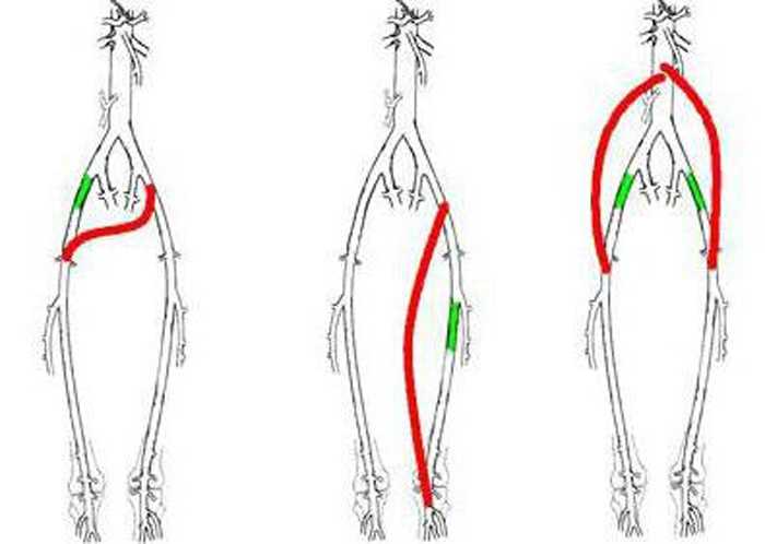 Операция на артерии нижних конечностей. Бедренно-подколенное шунтирование. Шунт бедренной артерии. Шунтирование нижних конечностей.