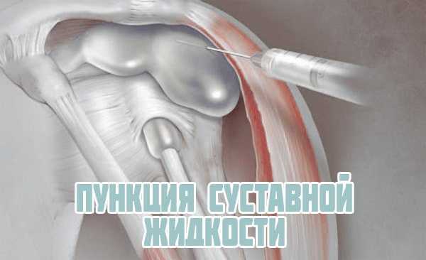 Внутрисуставные инъекции (уколы в сустав), внутрисуставные инъекции в коленный сустав.