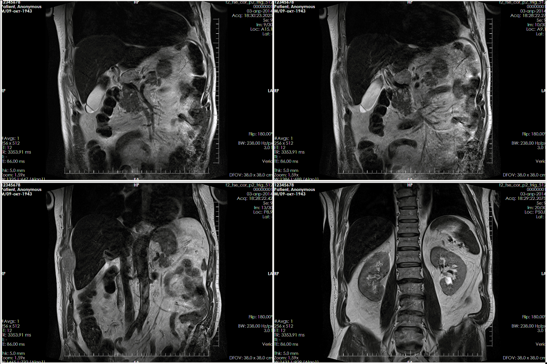 Мультиспиральная компьютерная томография с внутривенным болюсным усилением (кт с болюсным контрастированием)
