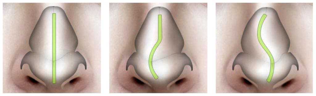 Нужна ли операция при искривлении носовой перегородки (носа)?