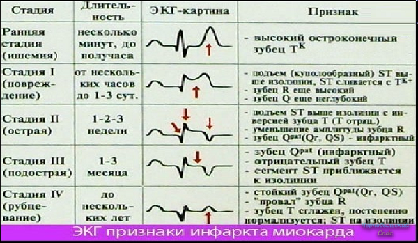 Расшифровка узи (эхокардиографии) сердца у взрослых и детей - таблица нормальных резултатов