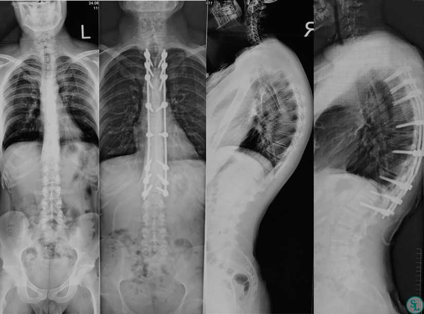 Рентгенологическая диагностика давности переломов ребер