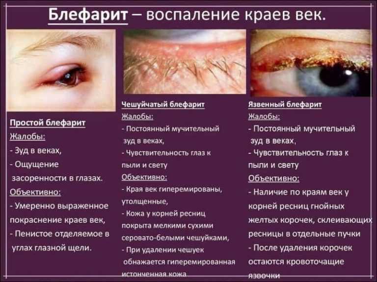Зондирование слезного канала у новорожденных и детей до года