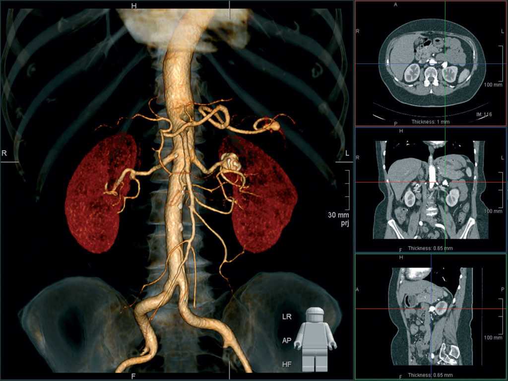 Мультиспиральная компьютерная томография с внутривенным болюсным усилением (кт с болюсным контрастированием)