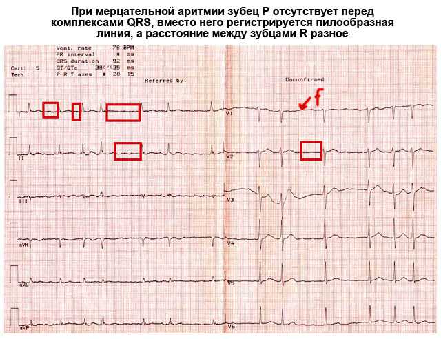 Эхокардиография сердца (эхо-кг, узи сердца)