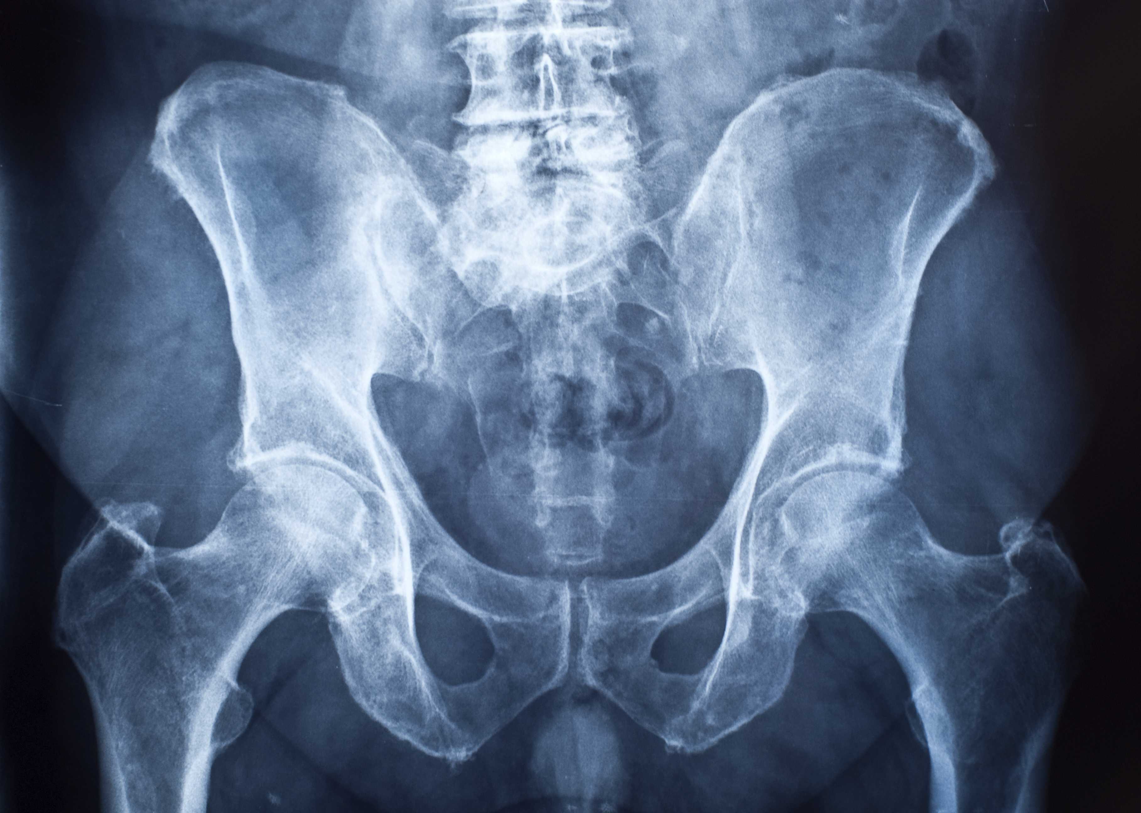 Рентгенография костей таза. полный справочник анализов и исследований в медицине