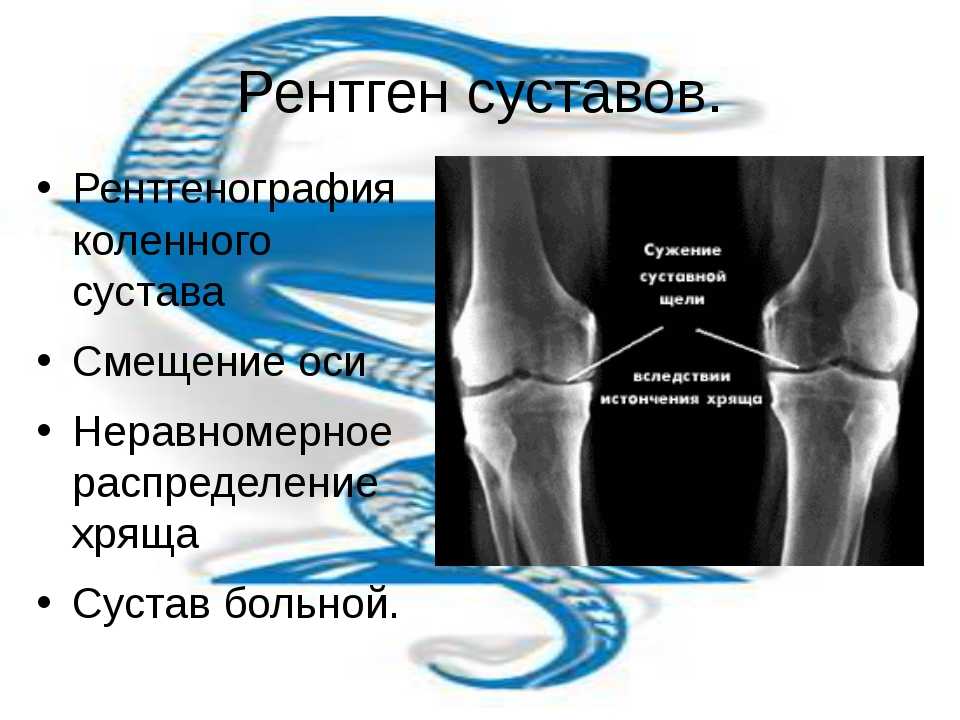 Рентген суставов. виды рентгеновского исследования суставов. показания, противопоказания, методика проведения