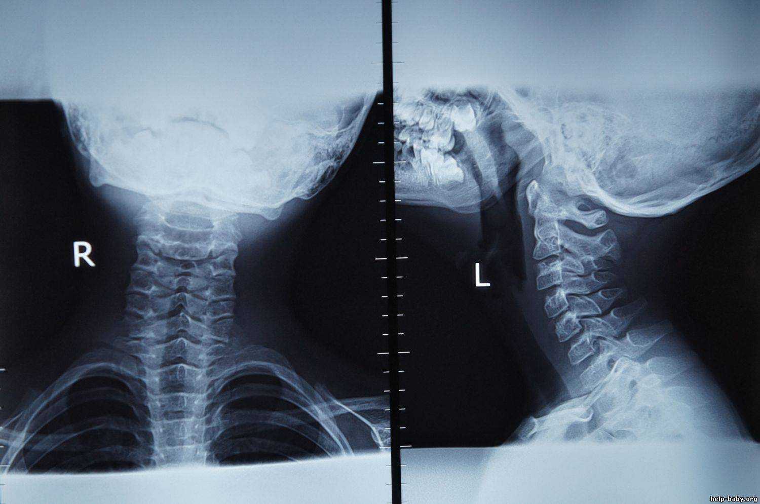 Рентген шейного отдела позвоночника. рентгенологическая картина в норме и при различных заболеваниях