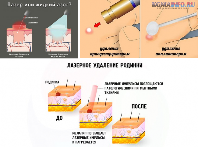 Где сделать удаление. Удаление родинок лазером. Заживление удаленной родинки лазером. Как Лазарем удаляют родинки.