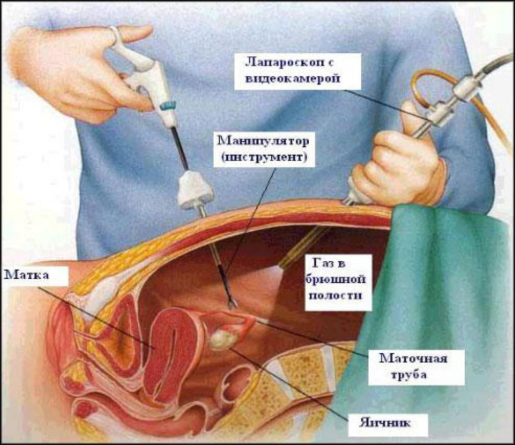 Лапароскопия маточных труб | eurolab | гинекология