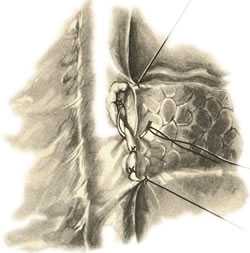 Илеостома: что это такое, показания к илеостомии, уход за стомой и питание после операции