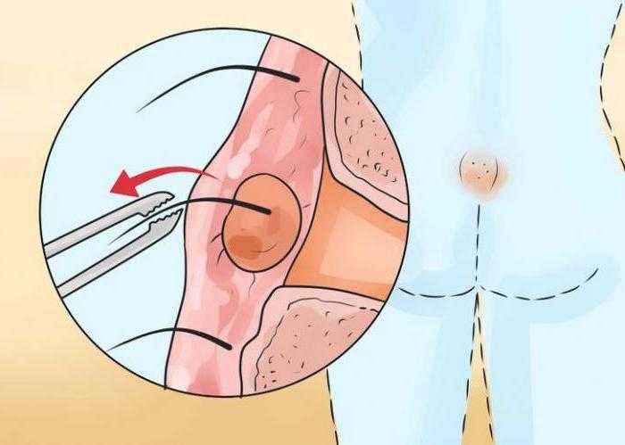 Лапароскопия кисты яичника: операция, удаление кисты яичника у женщин, восстановление после лапароскопии, операция | клиники «евроонко»