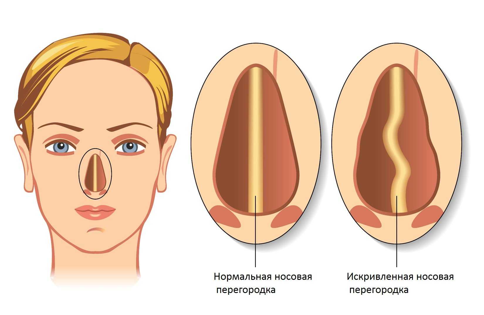 Для чего используется и кому назначается риноманометрия Как проходит диагностика при искривлении носовой перегородки и перед ринопластикой Рекомендации врача и меры безопасности