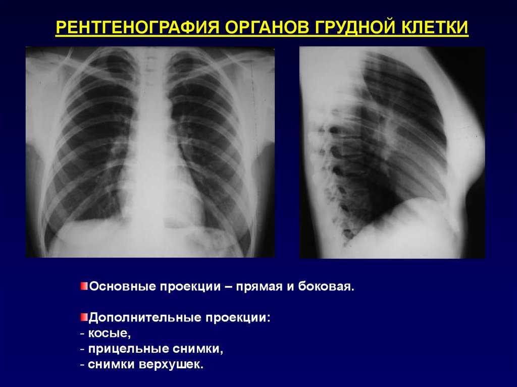 Рентген грудной клетки. показания и противопоказания. методика проведения. описание рентгенографии здоровой грудной клетки