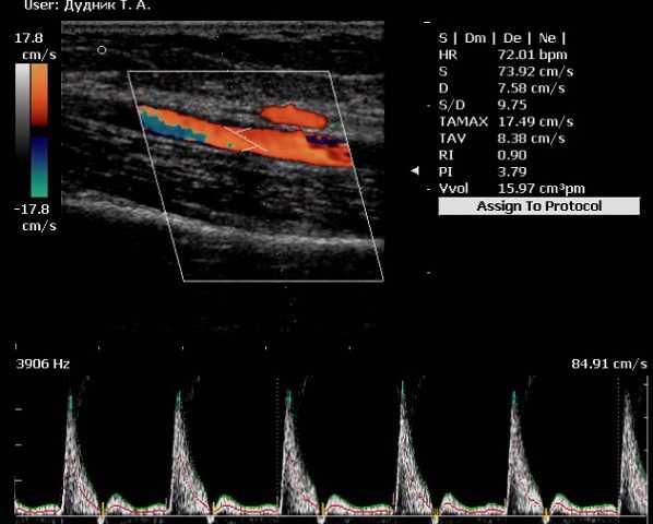 Триплексное сканирование экстракраниальных и интракраниальных отделов брахиоцефальных артерий