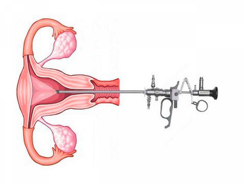 Анализ аспирационная биопсия эндометрия матки - показания, подготовка и расшифровка результатов