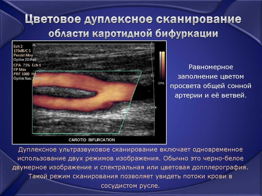 Дуплексное сканирование вен