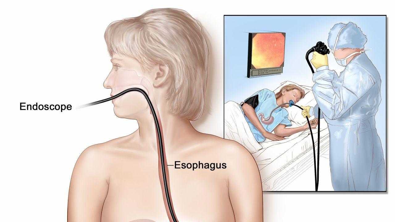 Прямая эндоскопия. Гастроскопия (ЭГДС, ФГДС). Эндоскопия пищевода ФГДС. Эзофагогастродуоденоскопия схема.