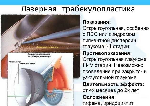 Что нельзя делать при глаукоме. Операция глаукома лазерная трабекулопластика. Первичная открытоугольная глаукома осложнения. Селективная лазерная Трабе. Селективная лазерная трабекулопластика глаза.