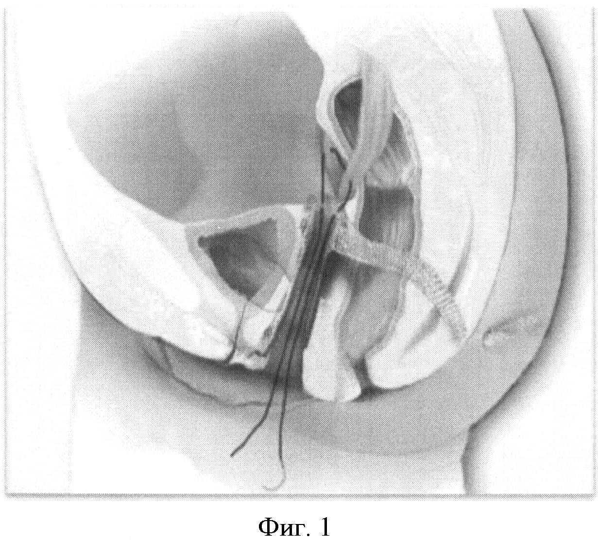 Опущение матки (выпадение) - степени 1, 2, 3 и 4, фото и лечение
