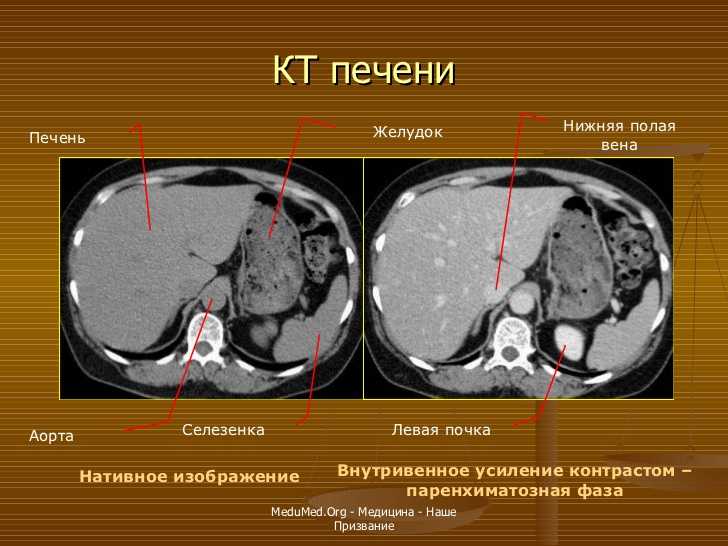 Компьютерная томография органов брюшной полости — что показывает? сделать кт брюшной полости в цэлт.