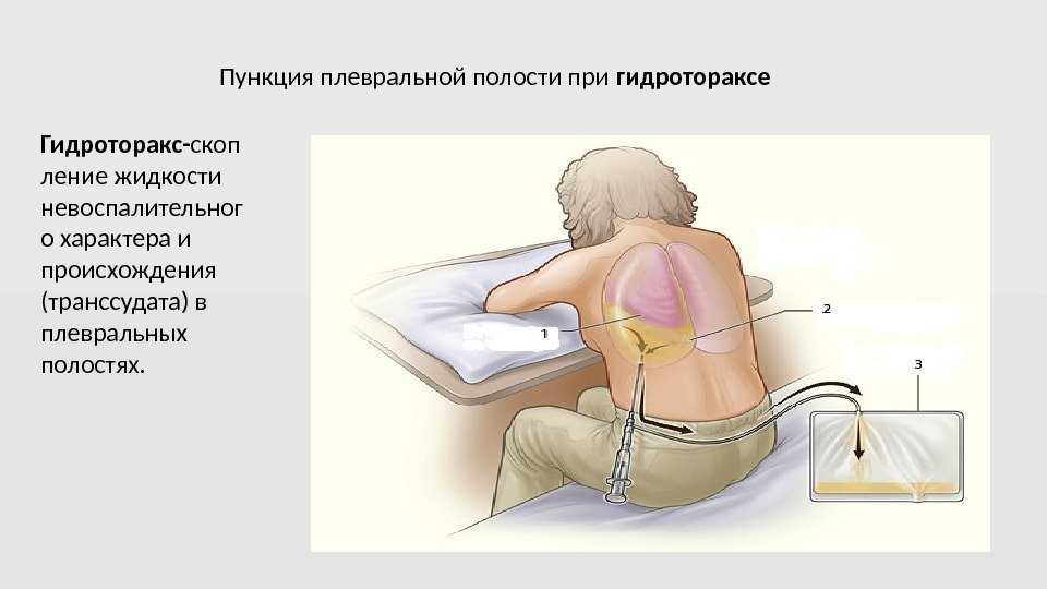 Плевральная пункция: подготовка пациента, техника проведения и осложнения | prof-medstail.ru