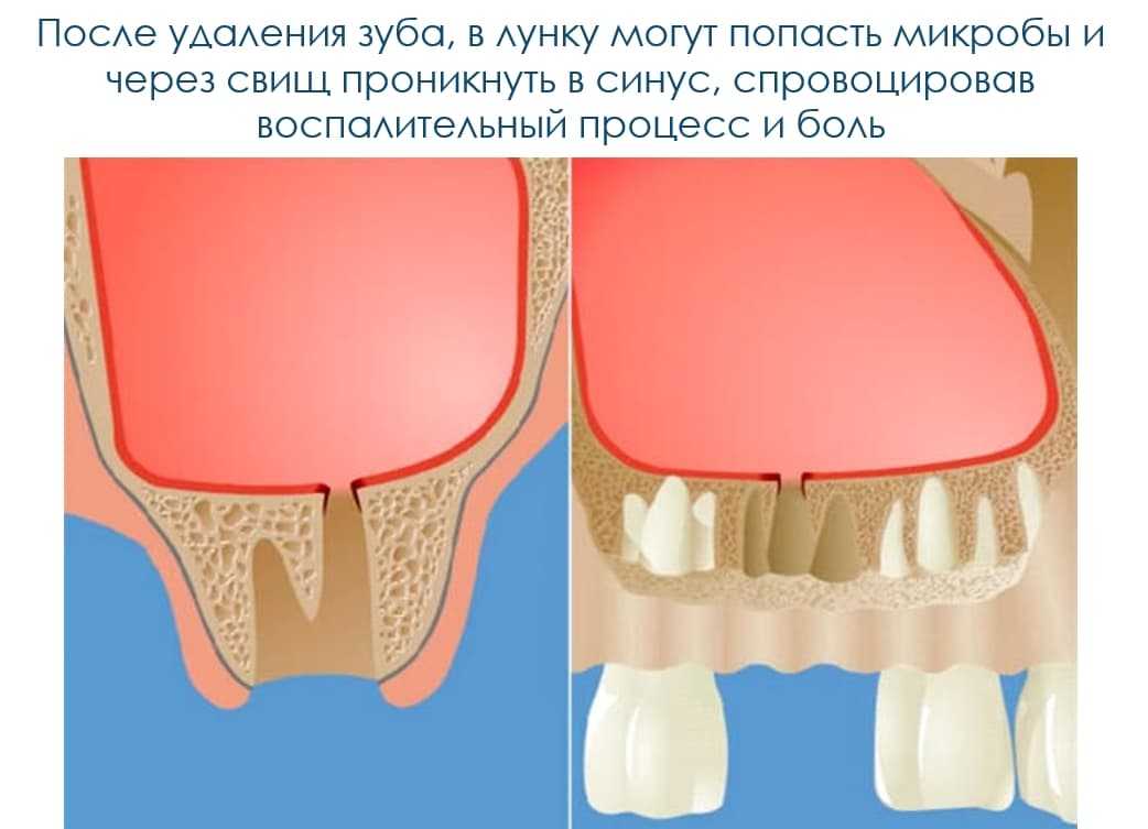 Воспаление десен после удаления зуба