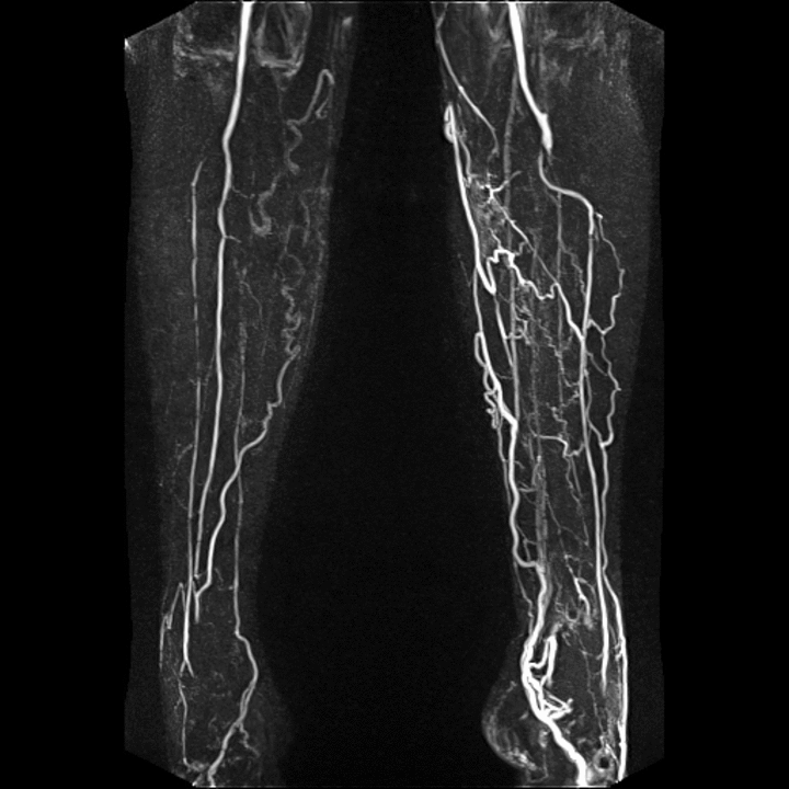 Ангиография артерий нижних конечностей в цкб ран